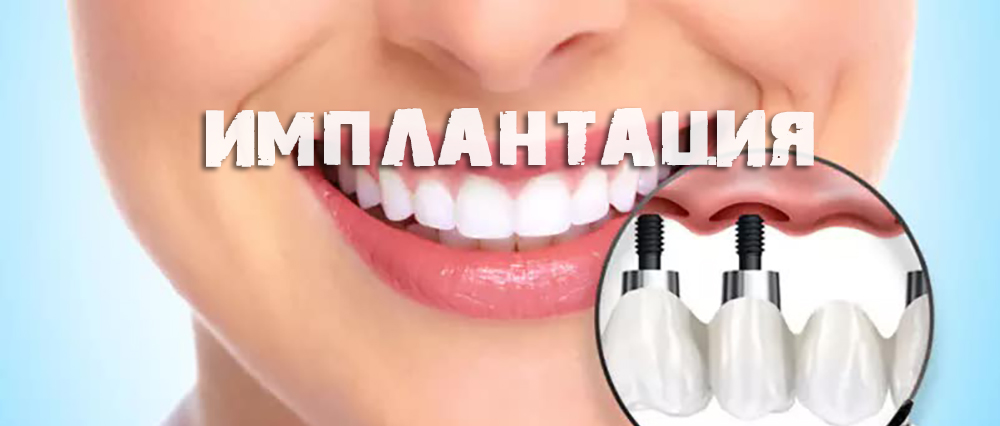 Имплантация зубов