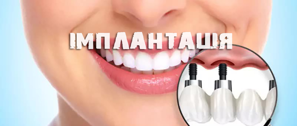 Імплантація зубів